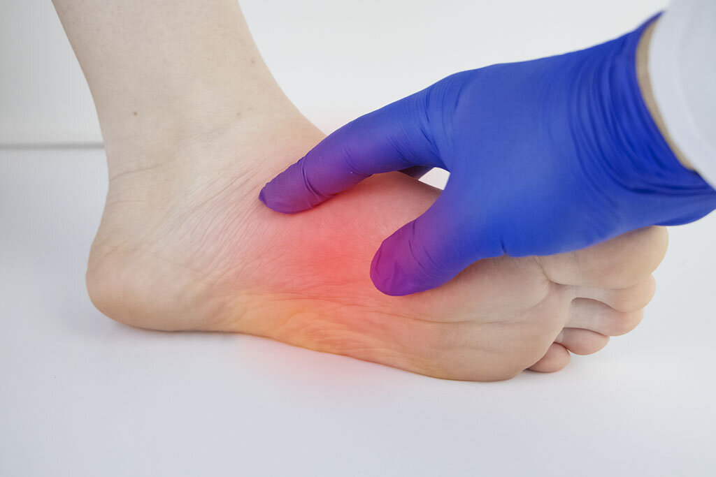4 Benefits Plantar Fasciitis Sufferers Gain By Using Chiropractic PMR